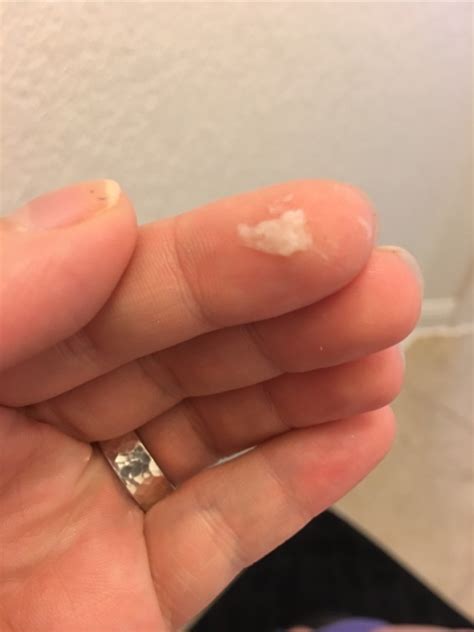 discharge 4dpo|cervical mucus early pregnancy pictures.